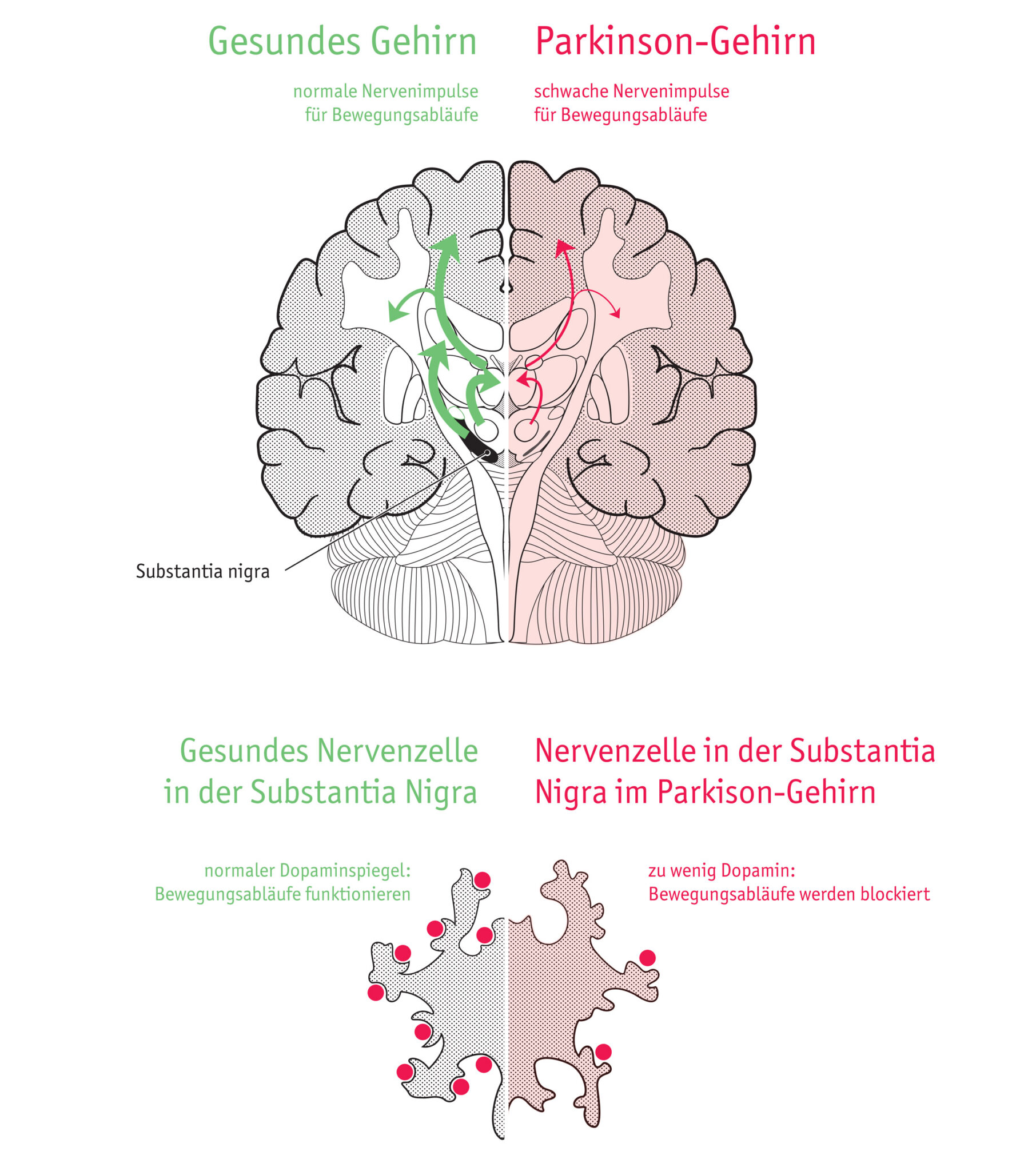 Parkinson’s Disease And Dopamine | Kasia Suchecka